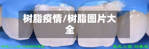 树脂疫情/树脂图片大全-第1张图片